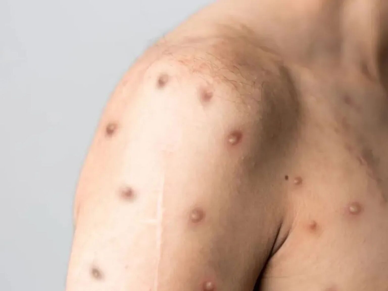Acre Registra Primeiro Caso de Mpox: Entenda o que Isso Significa Acre Registra Primeiro Caso de Mpox: Entenda o que Isso Significa