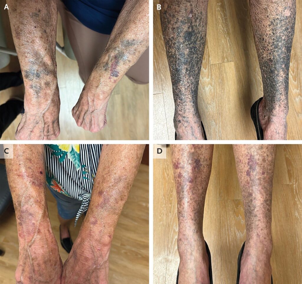 Efeitos Raros da Minociclina: Idosa dos EUA Apresenta Pele Azulada e Preta Após Uso de Antibiótico Efeitos Raros da Minociclina: Idosa dos EUA Apresenta Pele Azulada e Preta Após Uso de Antibiótico