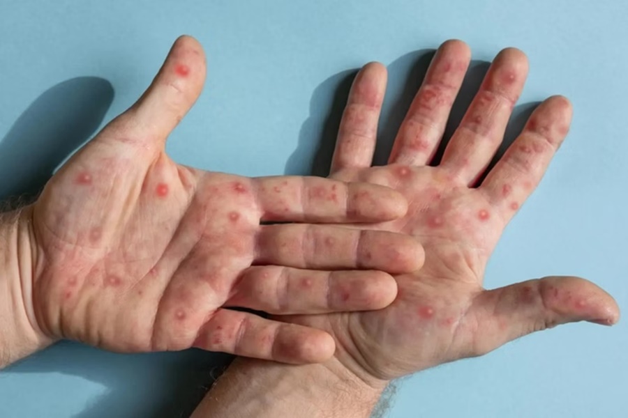 RN Registra Primeiros Casos de Mpox em 2026: Entenda o Que Está Acontecendo RN Registra Primeiros Casos de Mpox em 2026: Entenda o Que Está Acontecendo