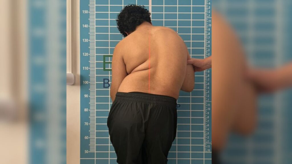 Adolescente com Síndrome Rara Luta Contra Escoliose Severas e Família Busca Ajuda Financeira Adolescente com Síndrome Rara Luta Contra Escoliose Severas e Família Busca Ajuda Financeira