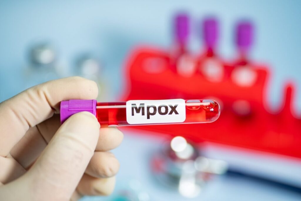 Minas Gerais Registra 7 Casos de Mpox em 2024 – Entenda os Sintomas e Prevenção Minas Gerais Registra 7 Casos de Mpox em 2024 - Entenda os Sintomas e Prevenção